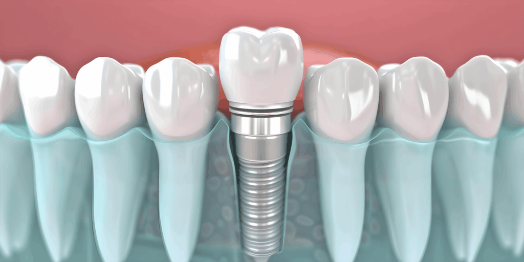 Dental Implants