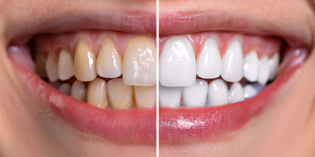 Veneers